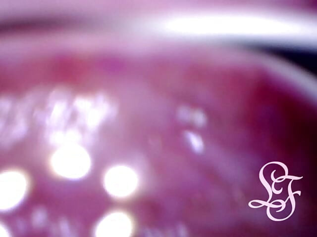 Can I fit the minicam AND a catheter inside my pee hole at the same time?