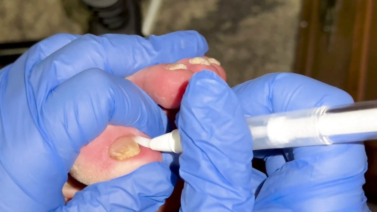 Chăm Sóc Và Thờ Phụng Bàn Chân Khô Ráp - FTM