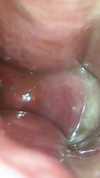 Endoscop examinarea pizdei și colului uterin