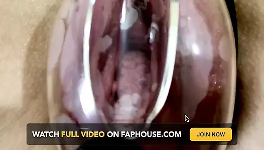 Вагинальная деформация под действием вакуумной насоса