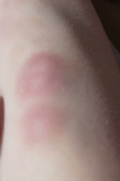 I Show You the Bruises on My Legs After Rough Sex