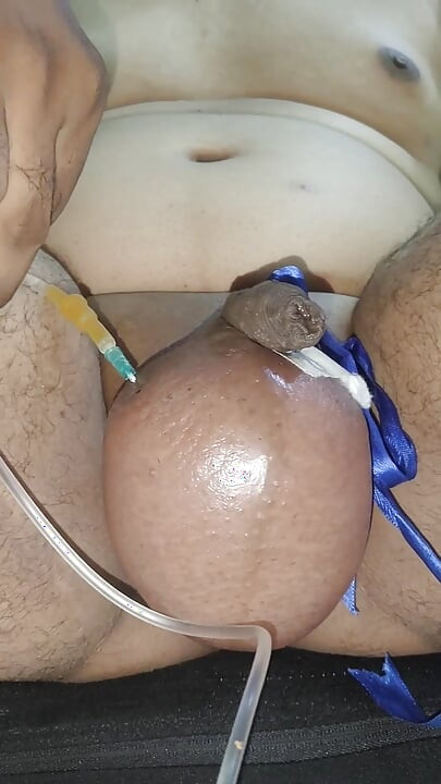 1 ltr saline infusion part 2