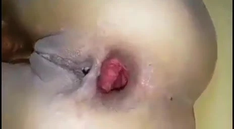Anal crashes