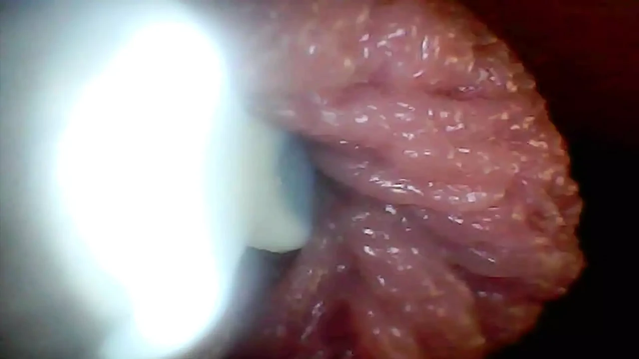 Endoscope Camera Shows the Most Sensitive Parts of the Penis Educational Video
