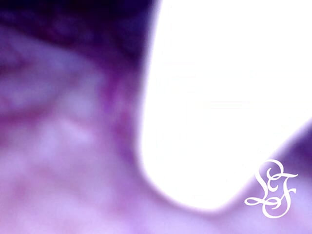 Can I fit the minicam AND a catheter inside my pee hole at the same time?