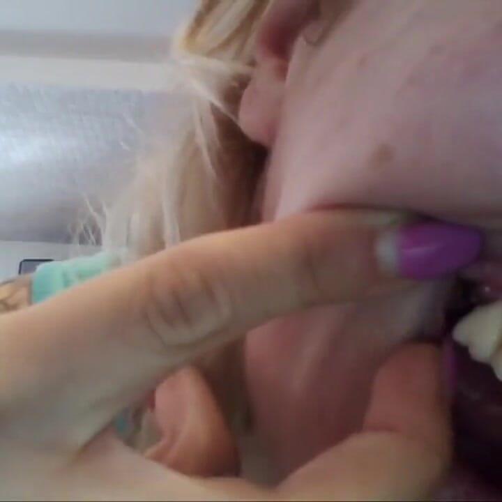 Chantal's Teeth Fall Apart, Rotten and Black