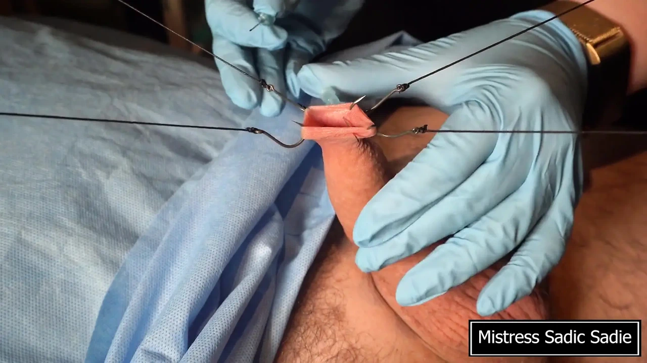 Needle CBT at It’s Finest.