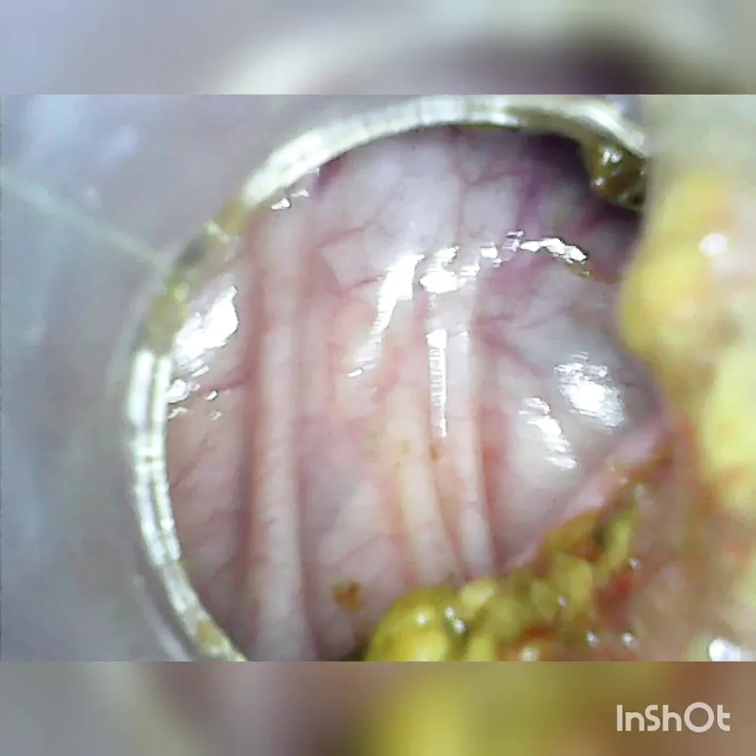 Deep deep anal again home colonoscopy Endoscope Part 1
