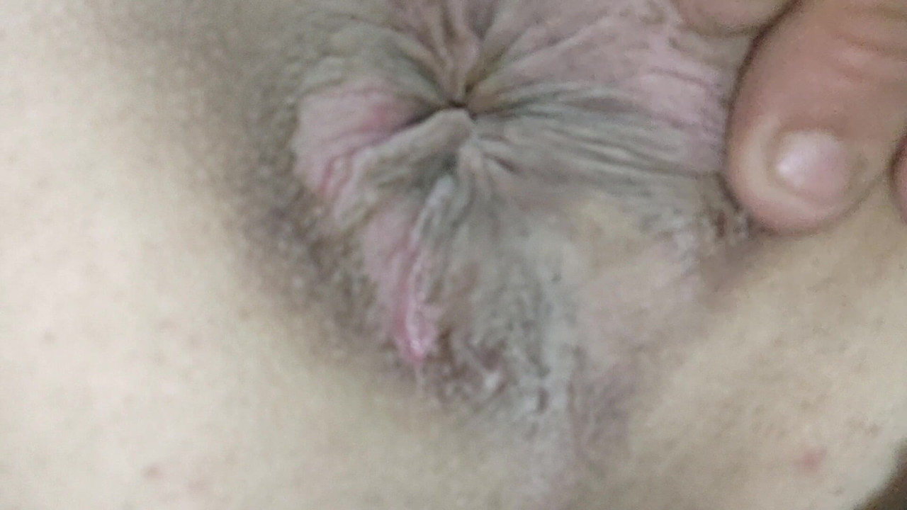 Extreme prolapsed anal