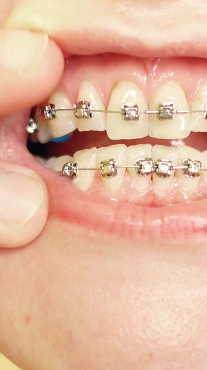 eating in braces - vore and food fetish - close up video | Clip 1