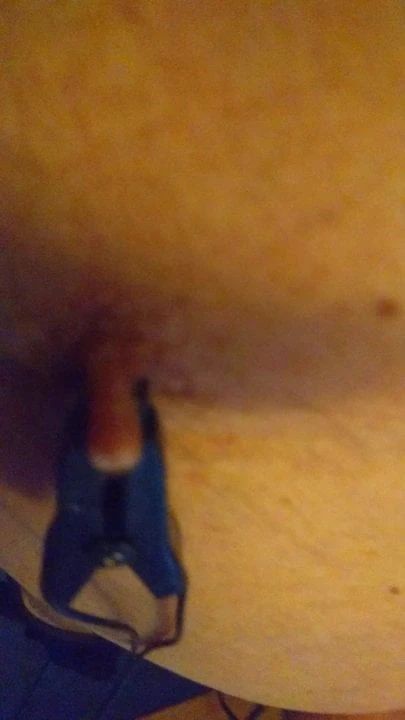 My bite