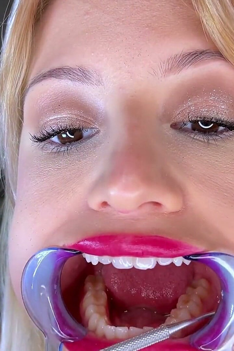 Examen de dientes retractores de la boca