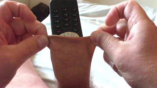 Crazy! Mobile phone in foreskin!