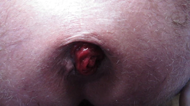 prolapse