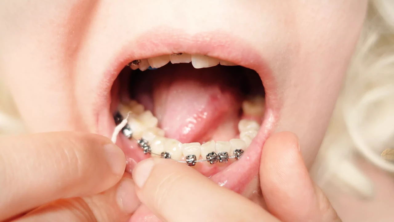 2nd day in braces - dental floss - close up mouth tour