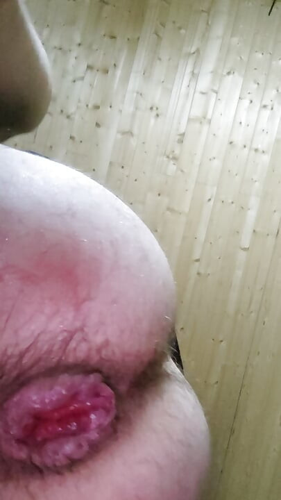 Anal Prolapse,Anal