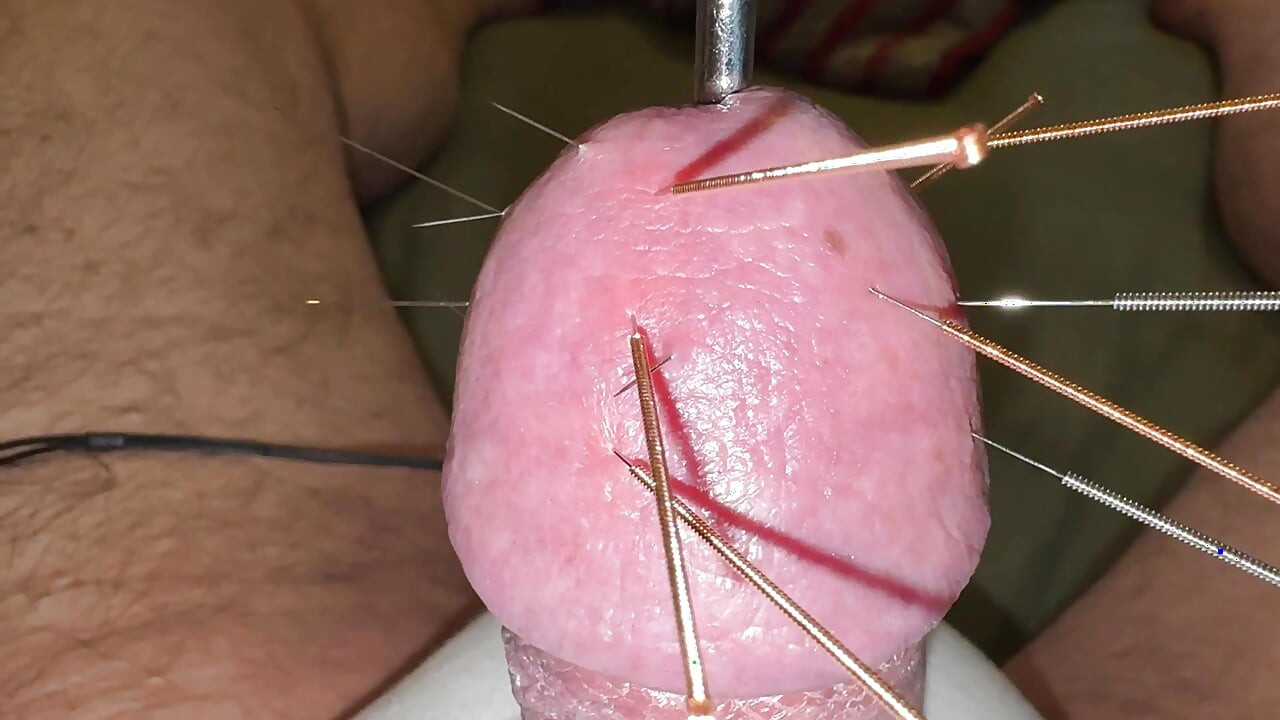 ¡acupuntura - ¡orgasmo!
