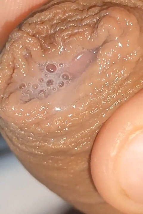 Περίεργο κοντινό πλάνο του Pre-Cum στο Flaccid Phimosis.