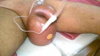 My friend doing saline infusion in my balls first time