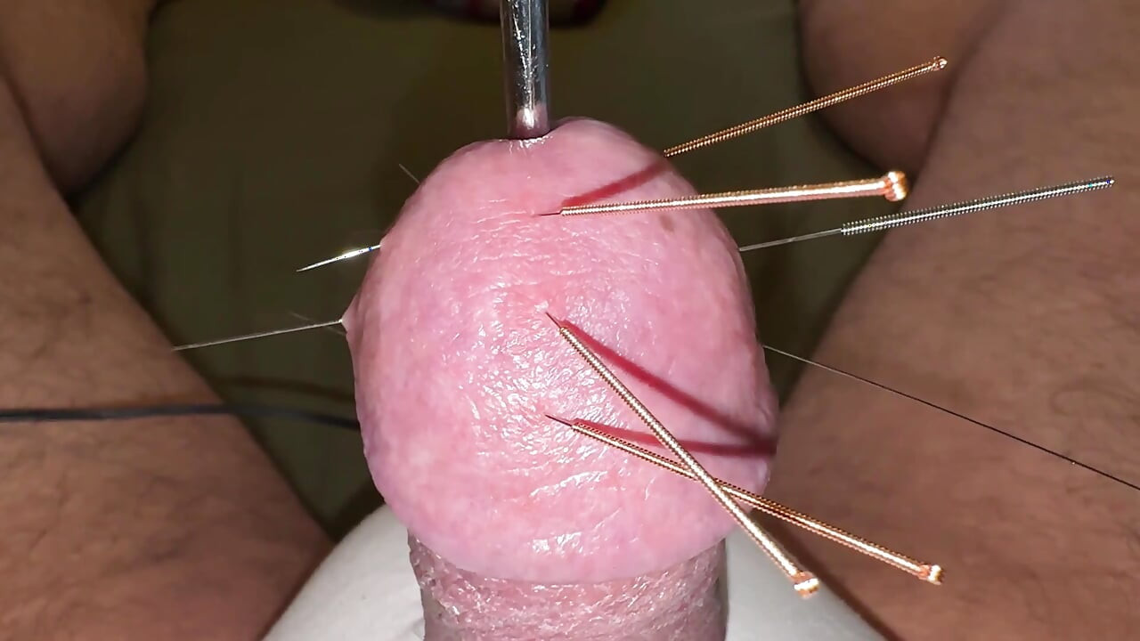 ¡acupuntura - ¡orgasmo!