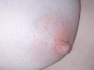 Puffy nipple