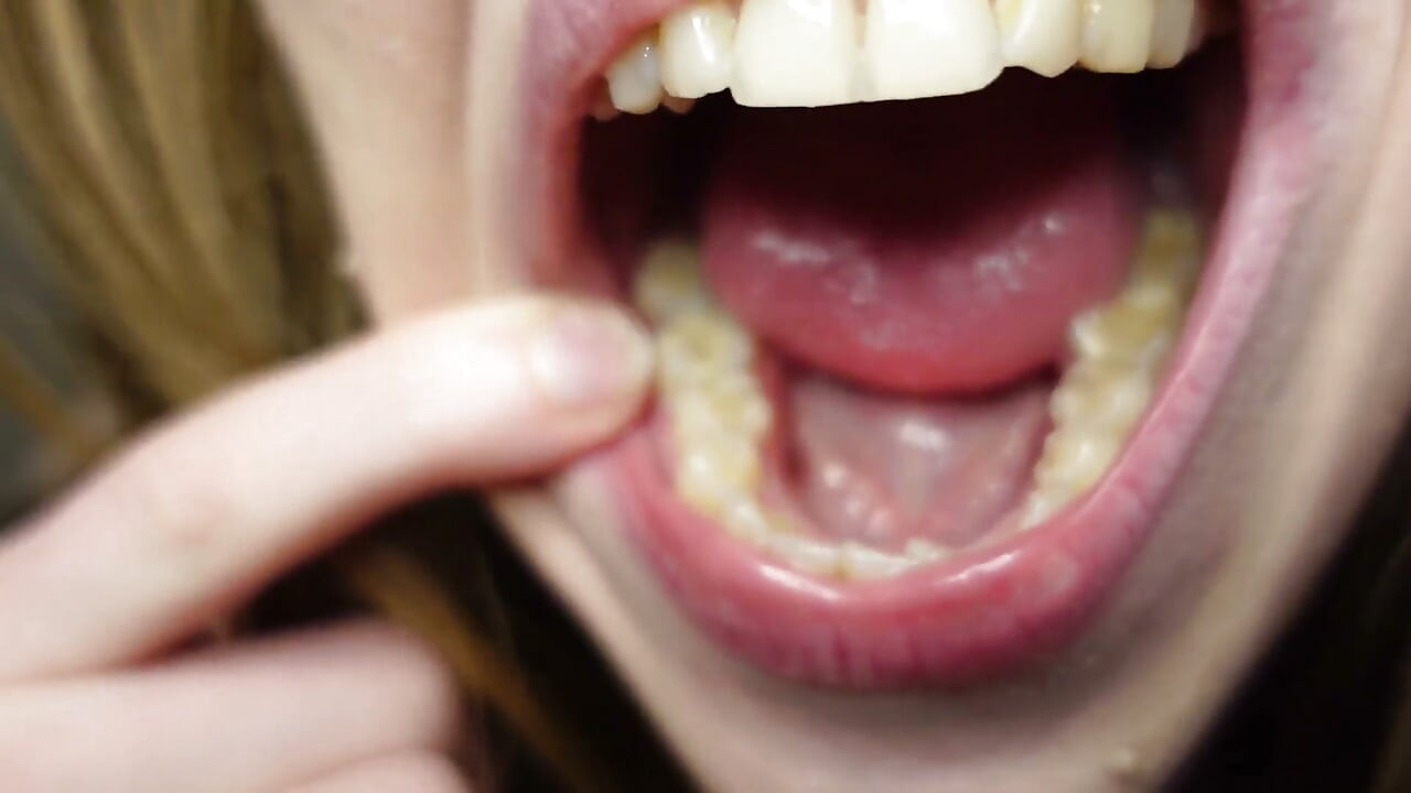 I Tell You About the Fillings in My Teeth and Dental Visits