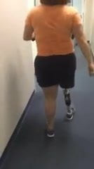 amputee walking