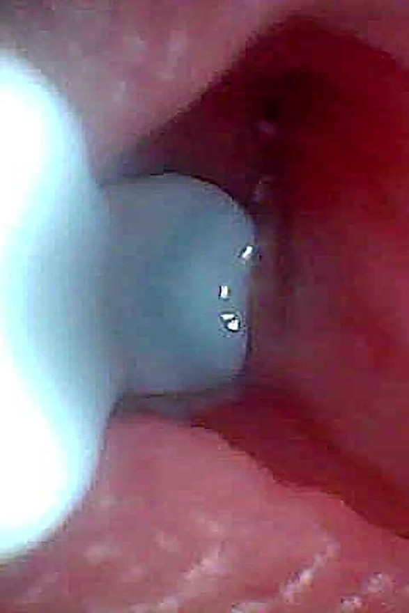 I Couldn’t Believe What Happens Inside the Penis as Sperm Passes Through (endoscopic Footage)