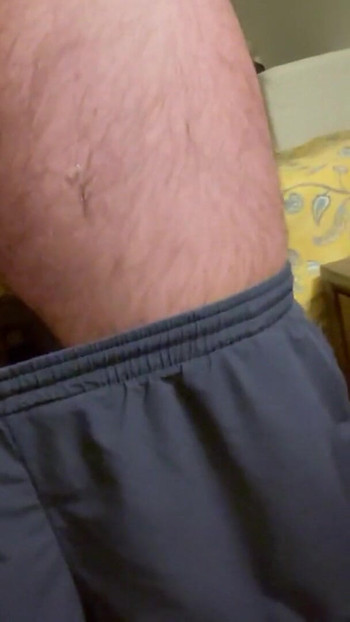 Zapanjujući trenutak iz "Peyronijeve bolesti"