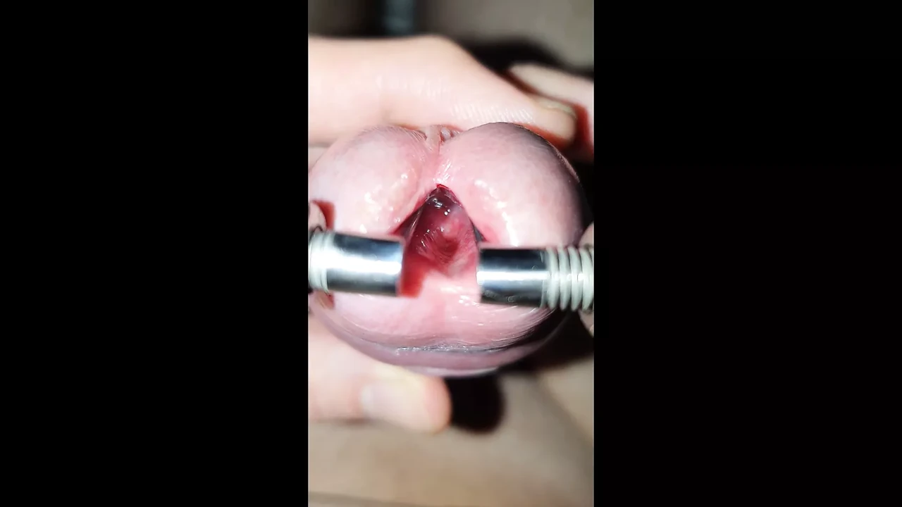 young urethra stretching to maximum, look inside and 10mm dilator inside
