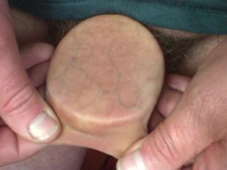 Foreskin with 3 dice and a plastic lid