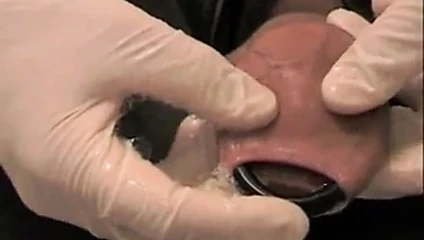 latex cockring foreskin