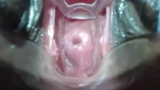 Shallow cervix penetration