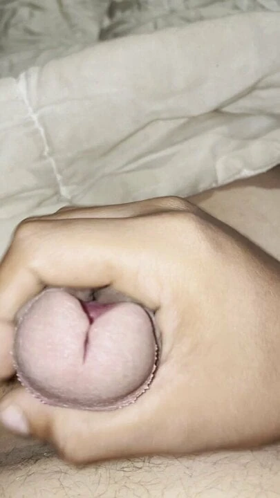 Subincision cum