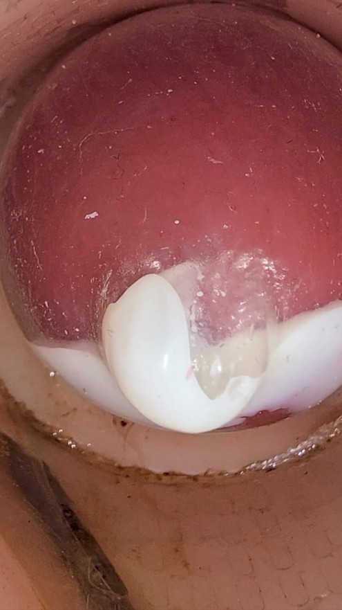 The Camera in the Deep Pussy Records a Huge Ejaculation of Sperm Into the Condom | Clip 1