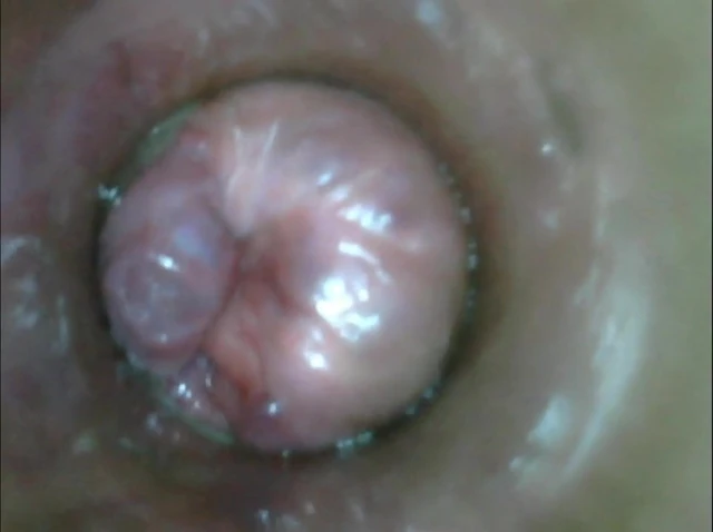 Anal Endoscope