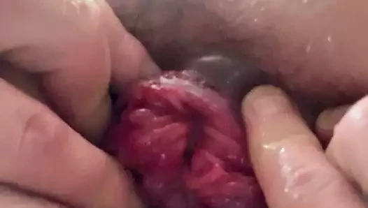 prolapsus anal