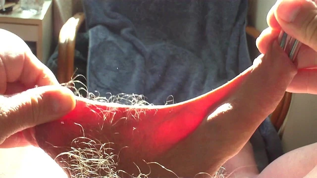 40 minutes - foreskin and scrotum in sunlight