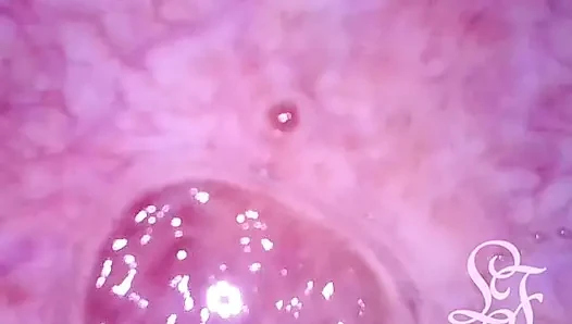 Can I fit the minicam AND a catheter inside my pee hole at the same time?