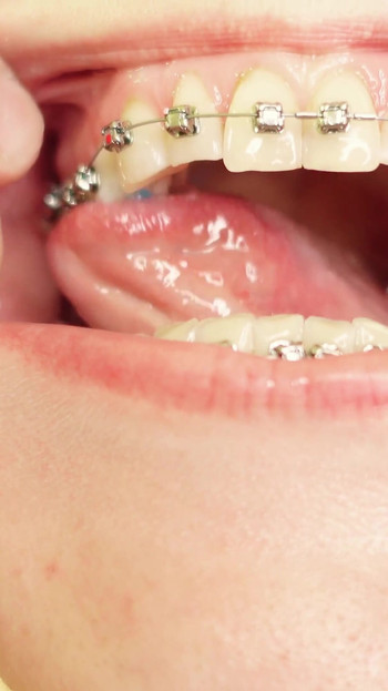 Iconic moment from "eating in braces - vore and food fetish - close up video"