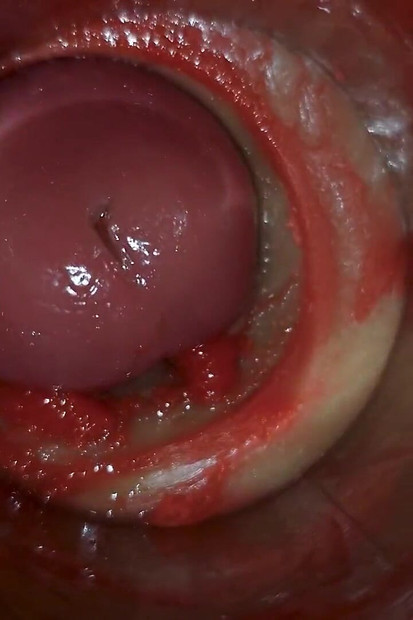 Kamera Unutar Duboke Pičke Snima Ogromnu Ejakulaciju Sperme Asmr