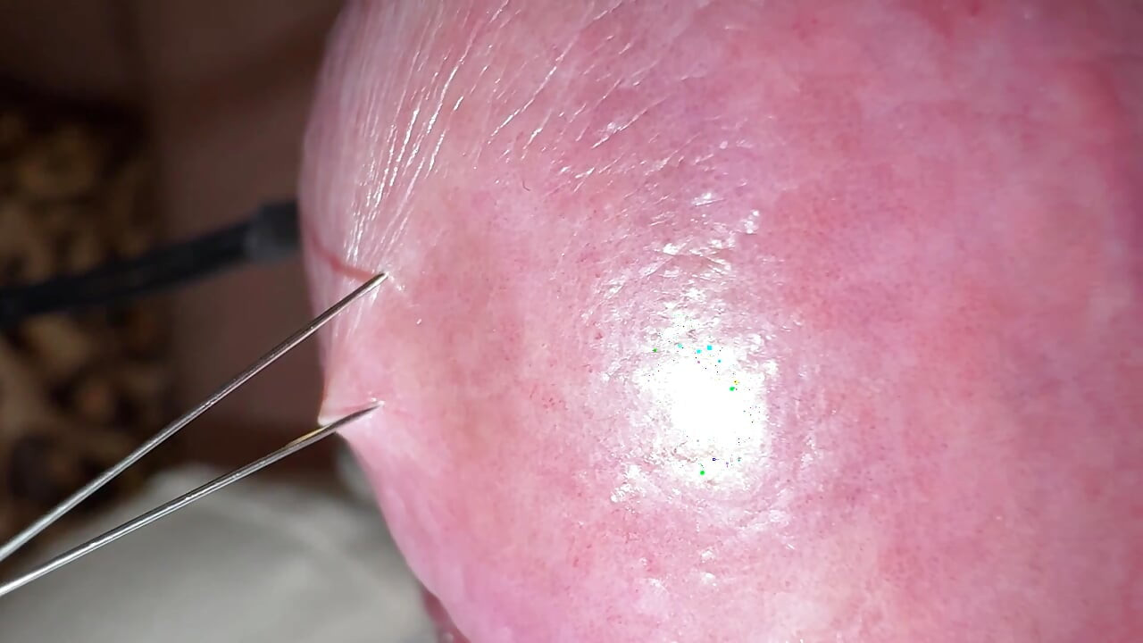 Needles through the hard glans!