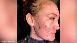 Donne con una brutta acne