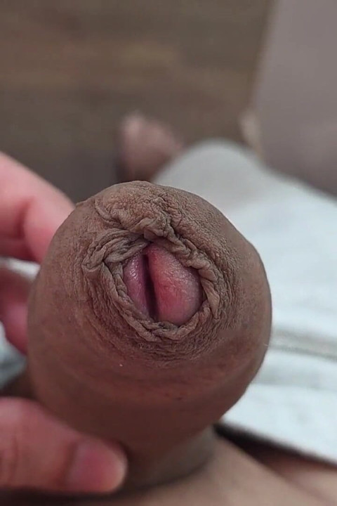 Phimosis