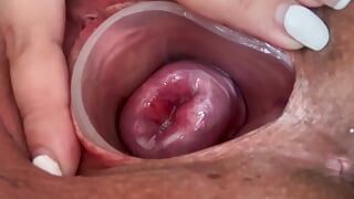 Kleiner Gebärmutterhals ohne Dilatation