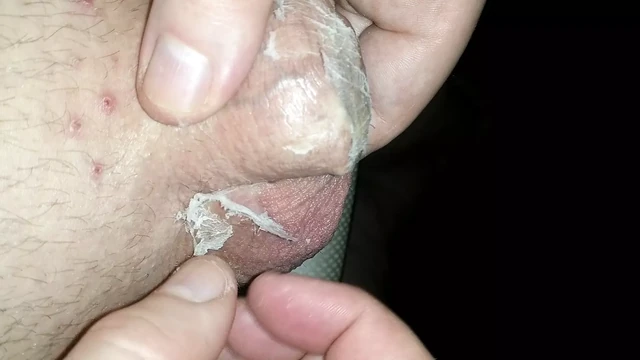 Freeing self from superglue