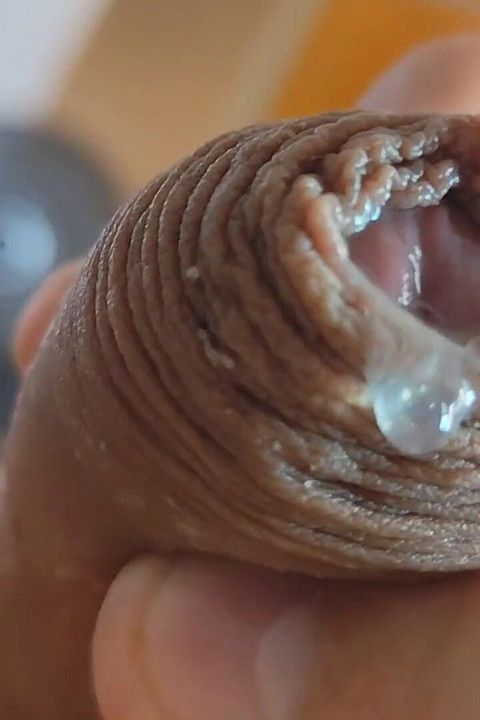 The Glans Appears Crowning Inside the Phimosis.