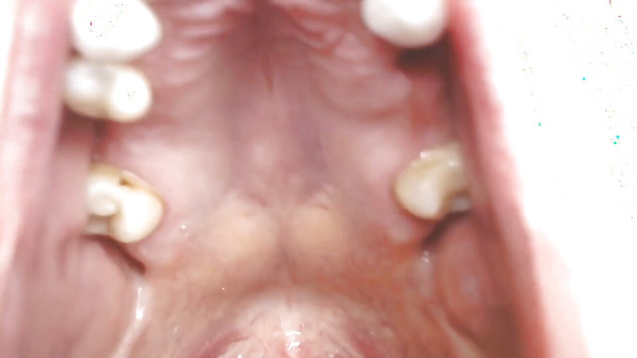 Gırtlağına ve ağzına tükürük ipleri olan Üveula Tonsils