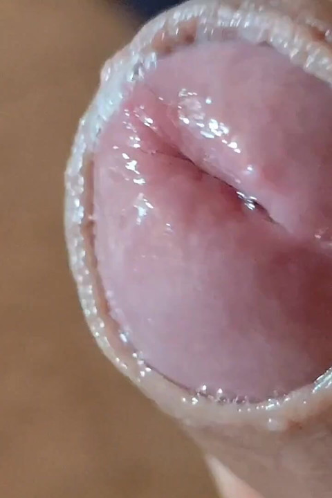 Glans'taki Derin Çatlak Kabarcıklı Sıvı Üretir.
