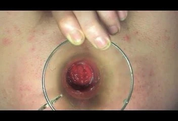 anal proslate insertion pluviometre